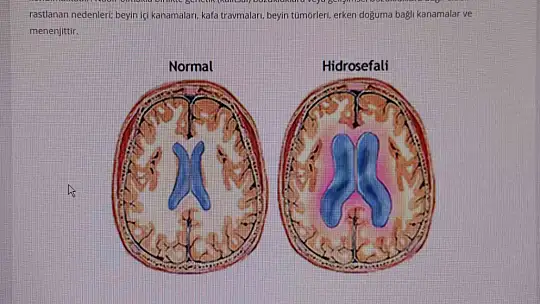 Beyin Cerrahı Uzmanı Op. Dr. Koparan: ''Hidrosefali, erken teşhis konulmazsa ölüme sebebiyet verebilir''
