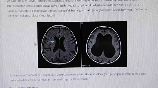Beyin Cerrahı Uzmanı Op. Dr. Koparan: ''Hidrosefali, erken teşhis konulmazsa ölüme sebebiyet verebilir''